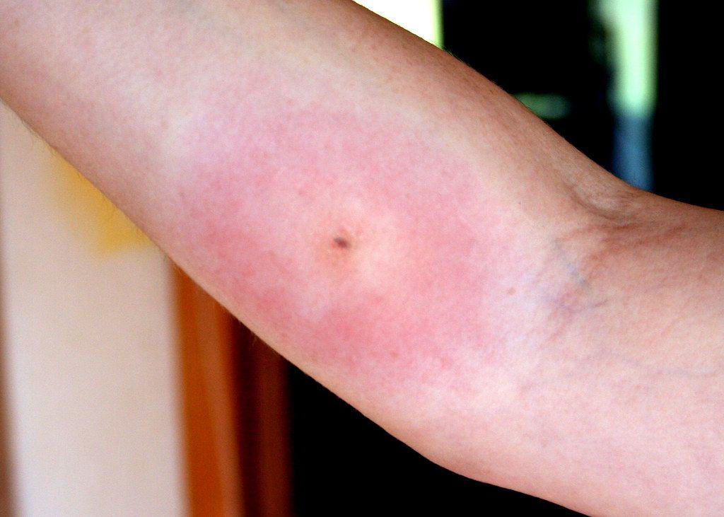 Early Cellulitis Insect Bite At Alana Saltau Blog